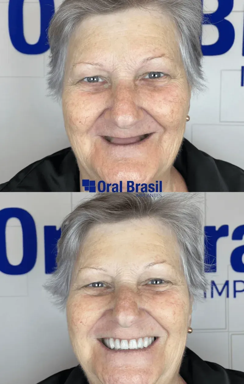 Sorriso transformado de paciente da Oral Brasil