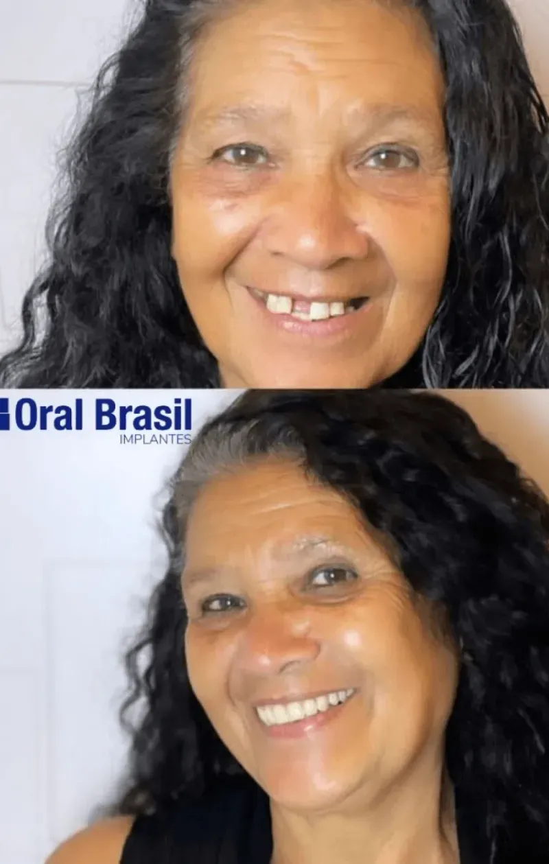 Sorriso transformado de paciente da Oral Brasil